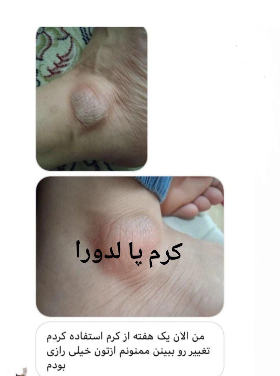 کرم ترک پای قوی لدورا ترمیم سریع ترک و خشکی|آرایشی، بهداشتی، درمانی|لاهیجان, شهید آوینی|دیوار