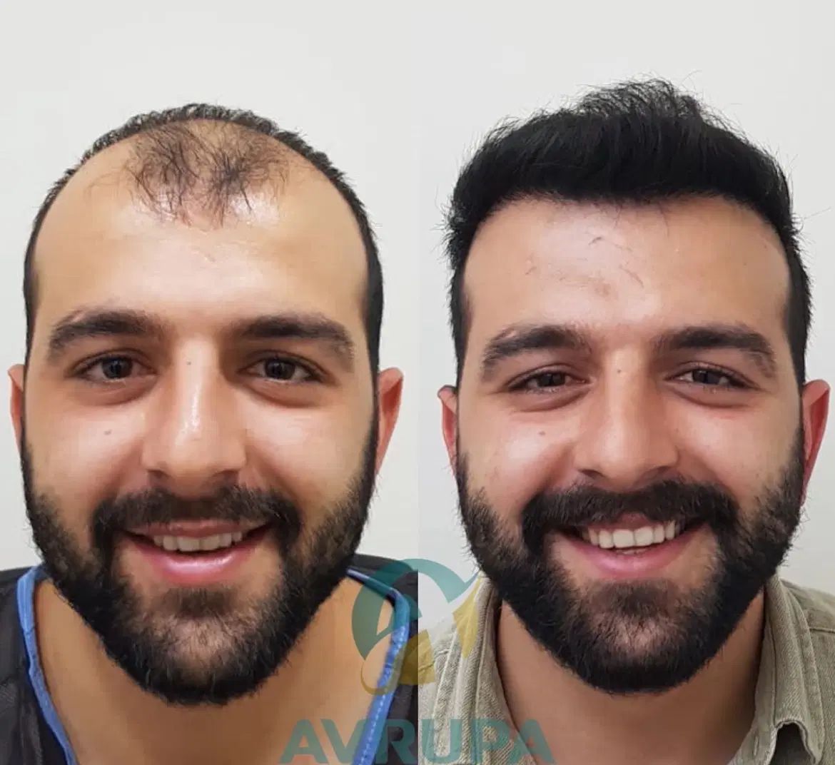 تو‌شهریور کاشت مو‌ هم‌جشنواره هم چکی فقط با ۱۵ ت|خدمات آرایشگری و زیبایی|تهران, جردن|دیوار
