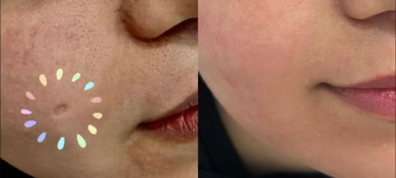 جشنوارهیلیزرCO2فرکشنال(رفعخال،ککومک،جایجوش)|خدمات آرایشگری و زیبایی|زنجان, |دیوار