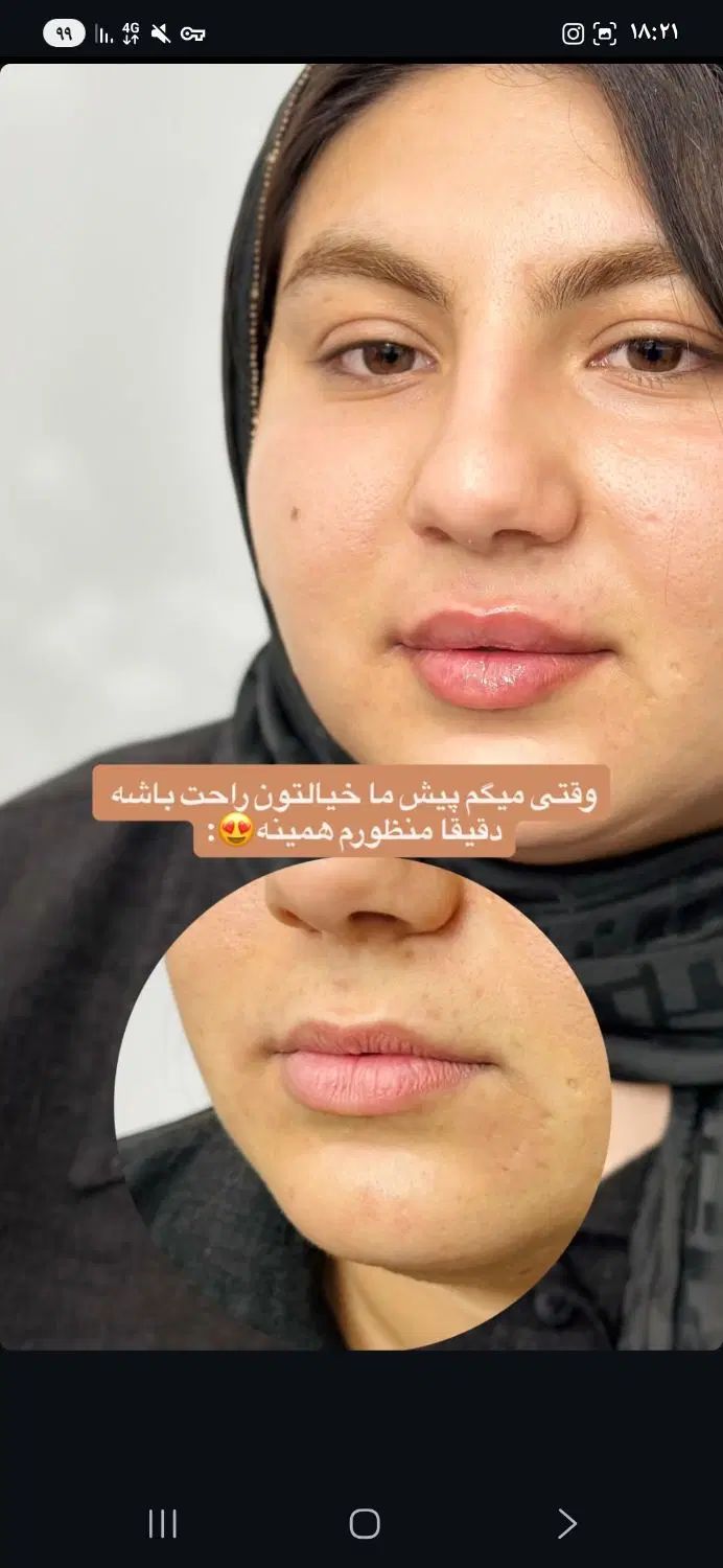 تزریق ژل و بوتاکس و فیشال تخصصی توسط پزشک|خدمات آرایشگری و زیبایی|برازجان, |دیوار