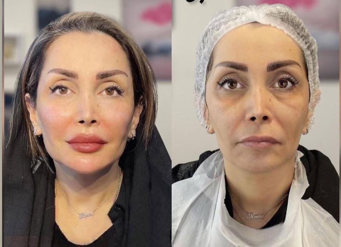 مدل روسی هایفو نخ کلینیک پوست بدون رقیب واقعی|خدمات آرایشگری و زیبایی|تهران, زعفرانیه|دیوار