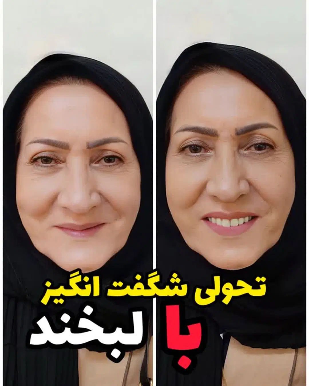 ساخت دندان مصنوعی طرح لمینت با قیمت اقتصادی|خدمات آرایشگری و زیبایی|یزد, |دیوار