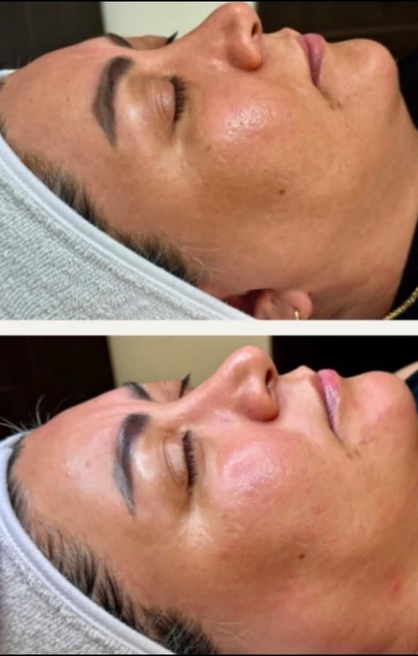 پاکسازی و فیشیال تخصصی و پلاژن تراپی ( فیشال )|خدمات آرایشگری و زیبایی|شیراز, شهرک قمشه|دیوار