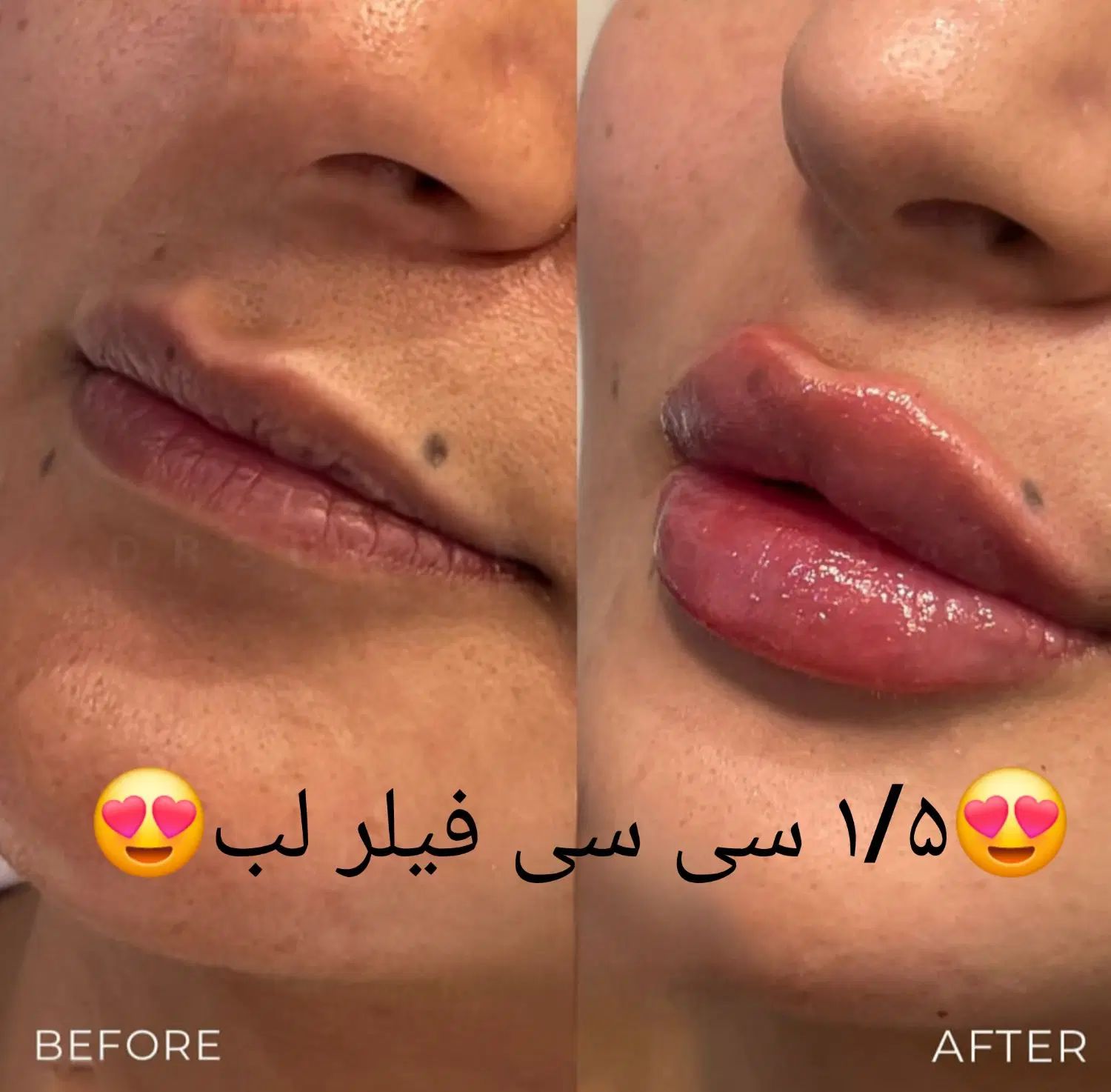 تزریق ژل فیلر بوتاکس مزوتراپی مزوژل لیزر فیشیال|خدمات آرایشگری و زیبایی|کرج, گوهردشت|دیوار