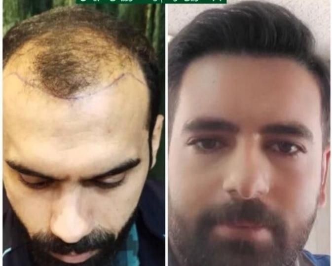 درمان ریزش مو و رویش مجدد کاملا تضمینی|خدمات آرایشگری و زیبایی|اصفهان, باغ زیار|دیوار