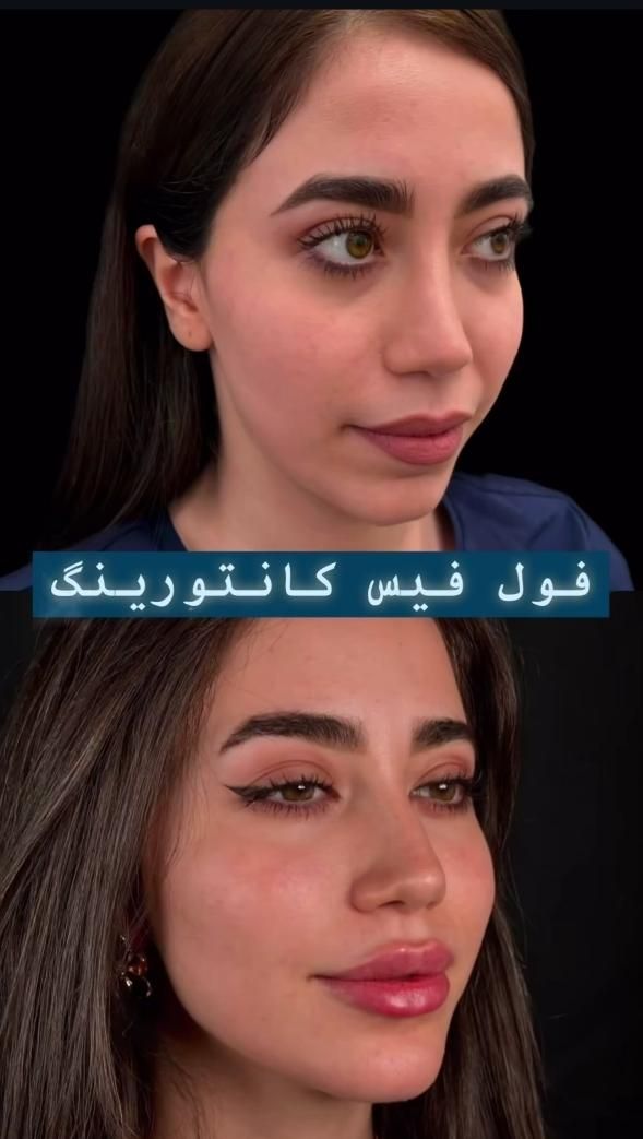 تزریق فیلر ژل/بوتاکس/prp پوست مو/پی آر‌پی/مزوتراپی|خدمات آرایشگری و زیبایی|کرج, گوهردشت|دیوار
