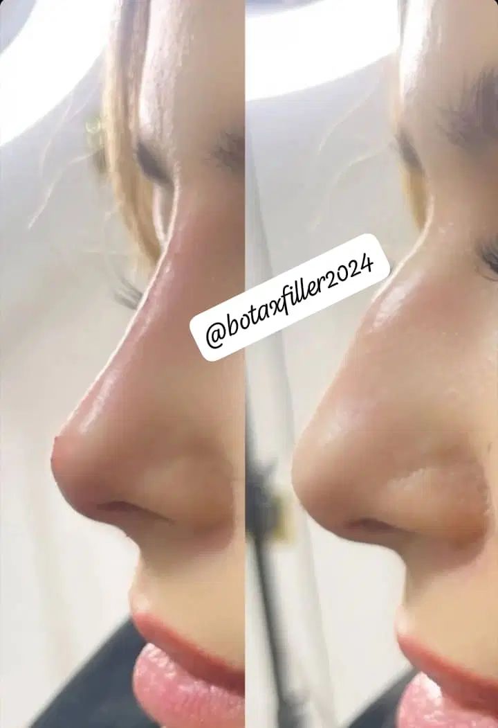 آموزش و خدمات تخصصی فیلر وبوتاکس|خدمات آموزشی|شیراز, معالیآباد|دیوار