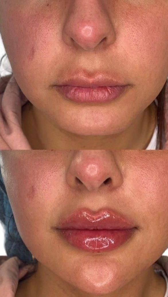 تزریق ژل بوتاکس مزونیدلینگ ، مزوسروابرو ،فیلربادی|خدمات آرایشگری و زیبایی|تهران, نیروی هوایی (پیروزی)|دیوار