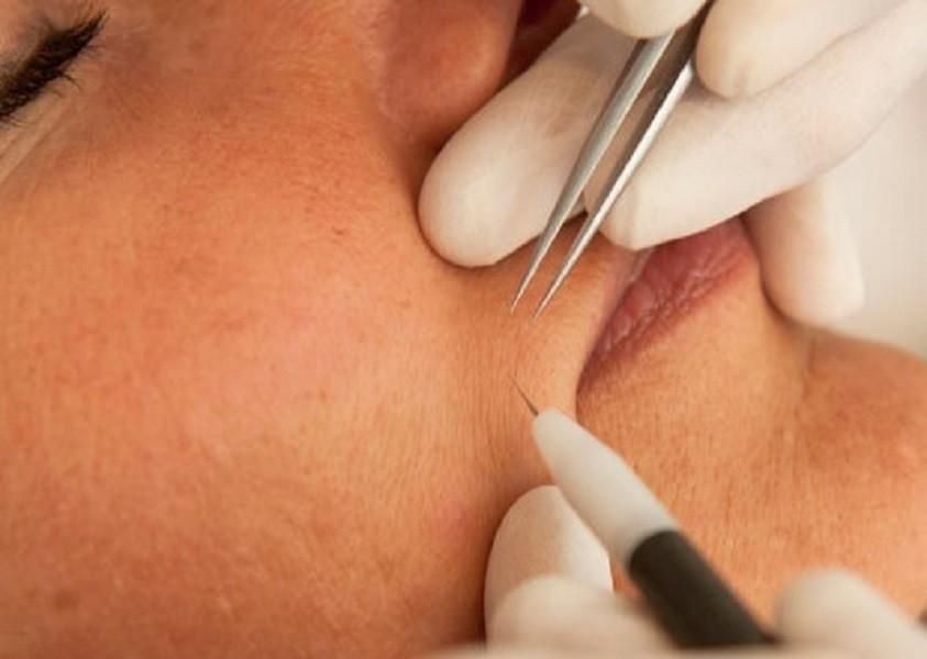 پاکسازی پوست الکترولیز لیزر مو پیرسینگ فیشیال|خدمات آرایشگری و زیبایی|تهران, مرزداران|دیوار