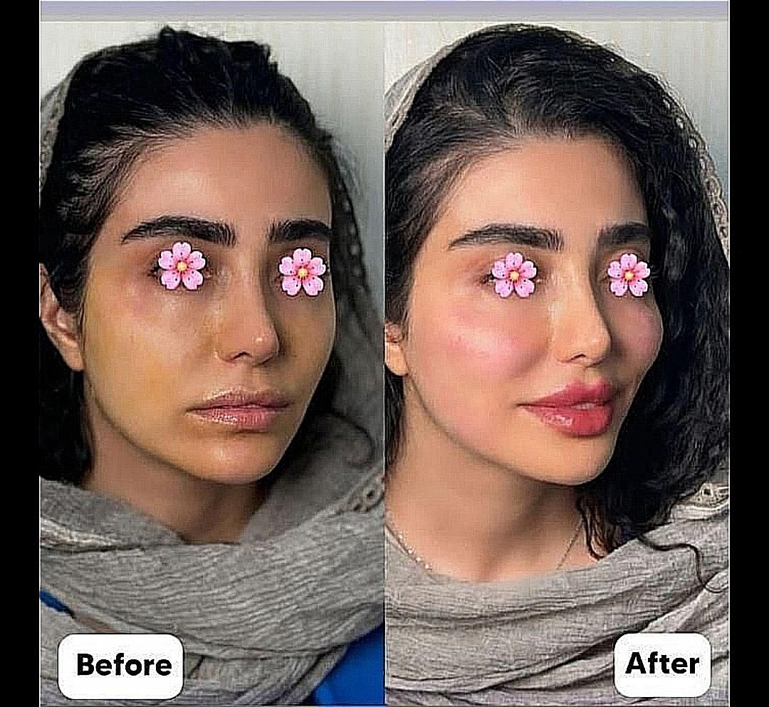 ژل بوتاکس عمل بینی ساکشن چربی در کلینیک بهنود|خدمات آرایشگری و زیبایی|تبریز, |دیوار