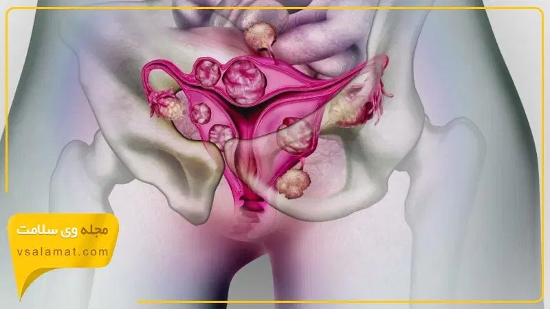 خداحافظی با مشکلات بانوان (کیست و فیبروم)|آرایشی، بهداشتی، درمانی|گرگان, |دیوار