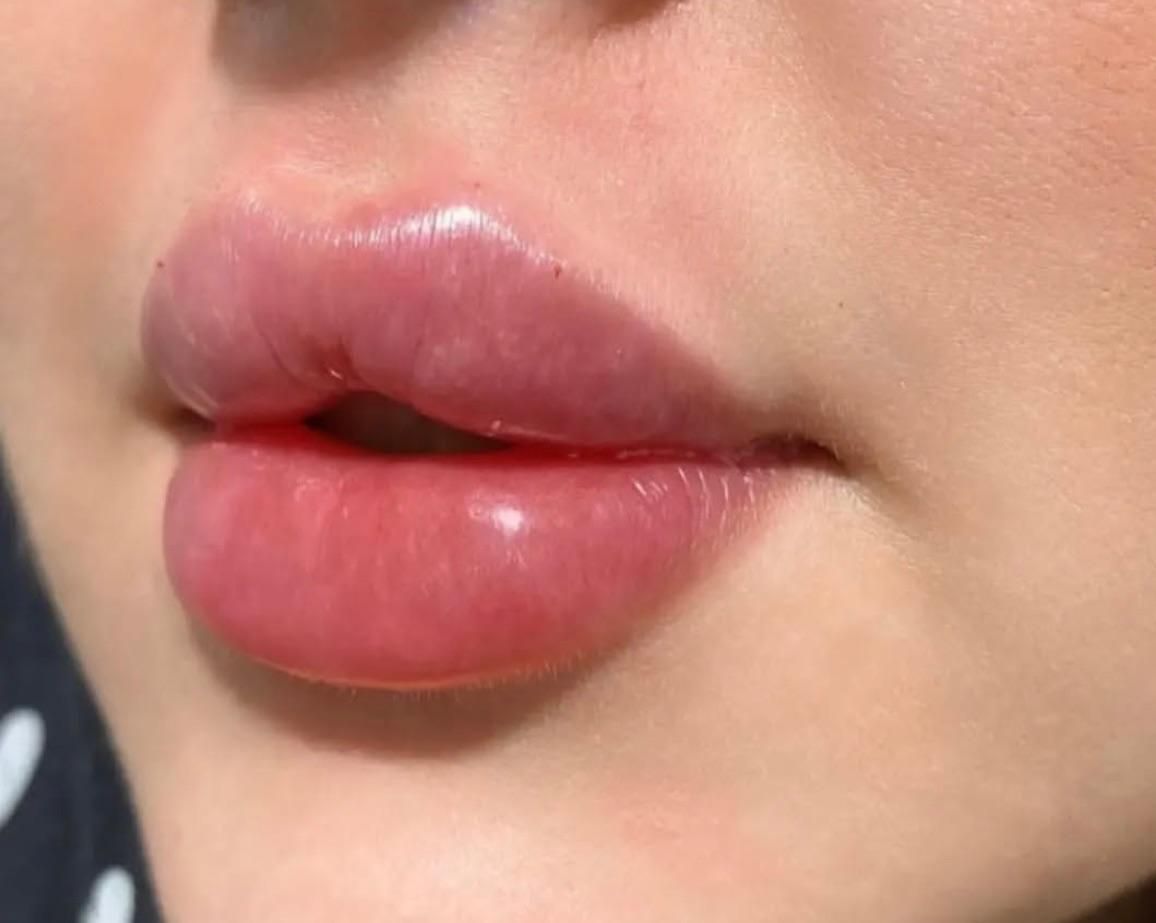 تخفیفات ژل و بوتاکس در مطب پزشک|خدمات آرایشگری و زیبایی|سنندج, |دیوار