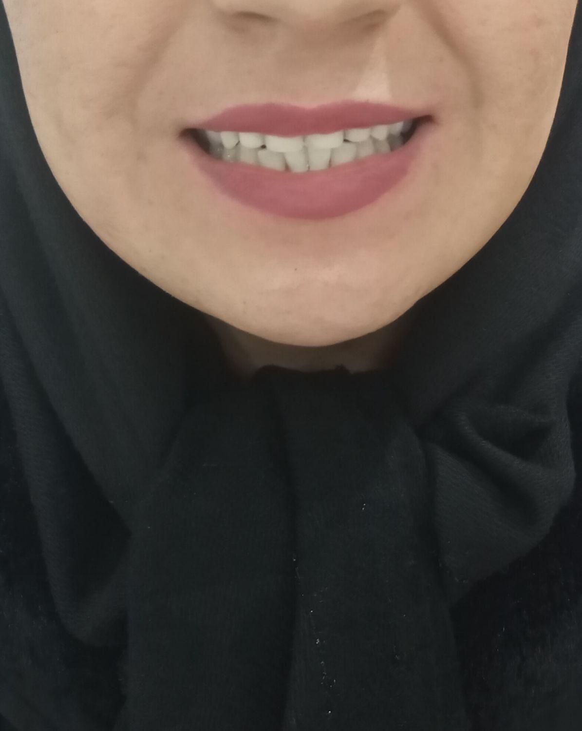 دندانسازی ( پروتز متحرک) لمینتی و کامپوزیتی|خدمات آرایشگری و زیبایی|مشهد, احمدآباد|دیوار