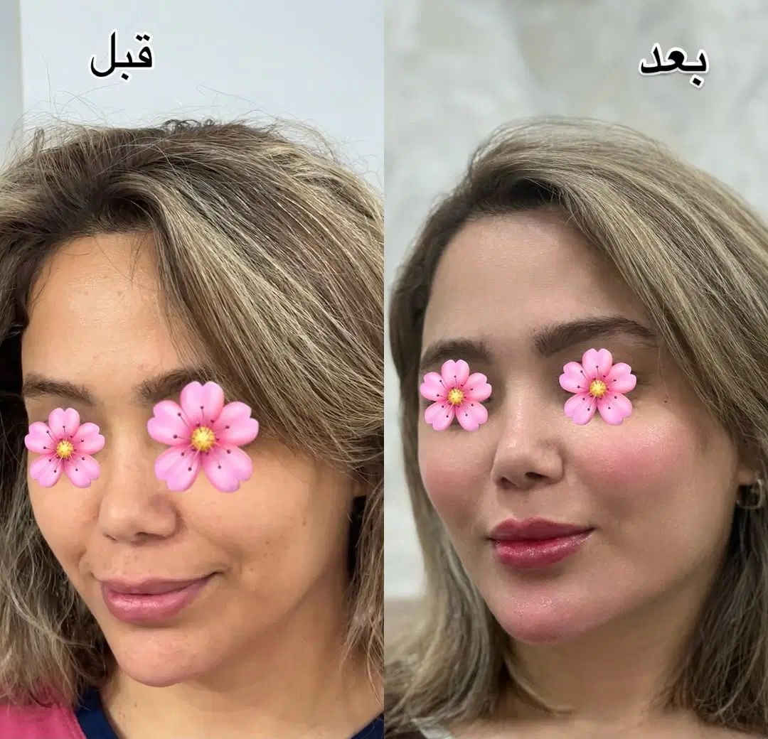 تخفیف ژل بوتاکس مزو آنزیم فیلر غبغب پی ارپی|خدمات آرایشگری و زیبایی|اصفهان, وحید|دیوار