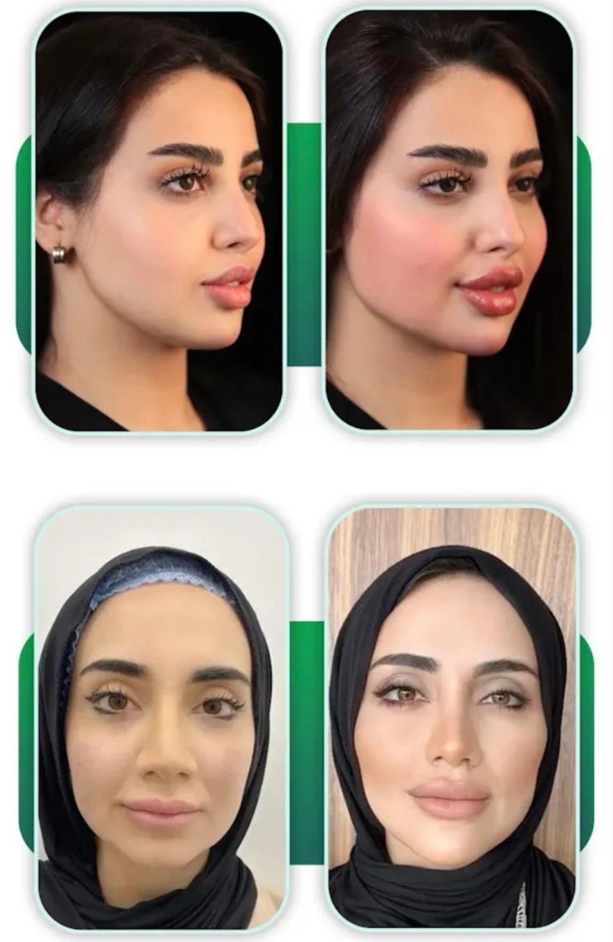 مدل تزریق لب روسی و کانتور صورت و تزریق بیکینی|خدمات آرایشگری و زیبایی|تهران, زعفرانیه|دیوار