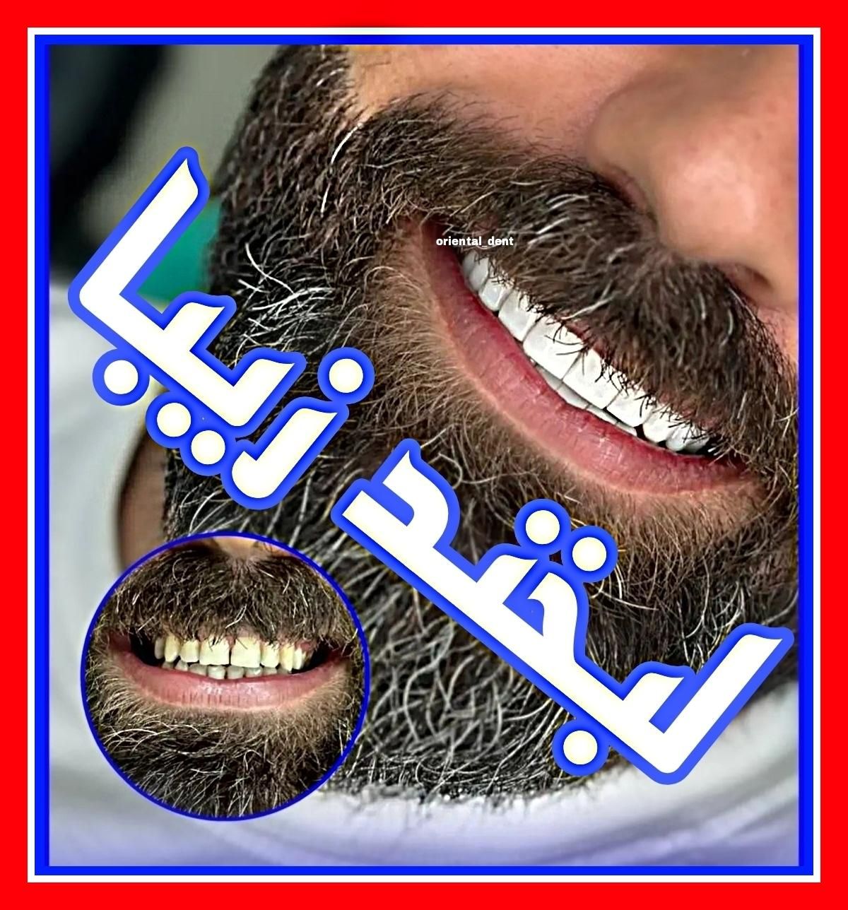 دندانپزشکی/کامپوزیت دندان/ترمیم/روکش/عصبکشی|خدمات آرایشگری و زیبایی|تهران, تهرانپارس شرقی|دیوار