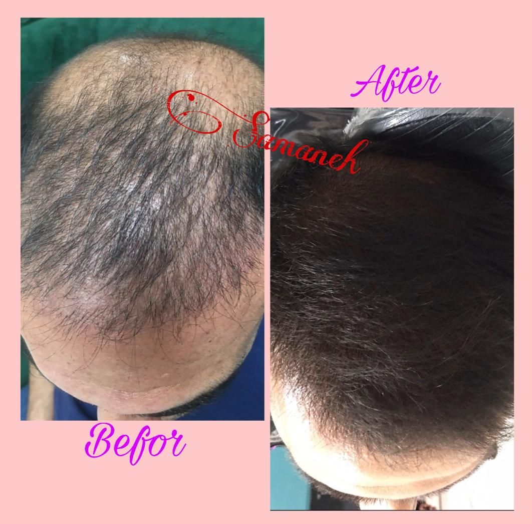 بوتاکس،ژل،چربی،ساکشن غبغب،آموزش سابسیژن پی ارپی|خدمات آرایشگری و زیبایی|اصفهان, شاهزید|دیوار
