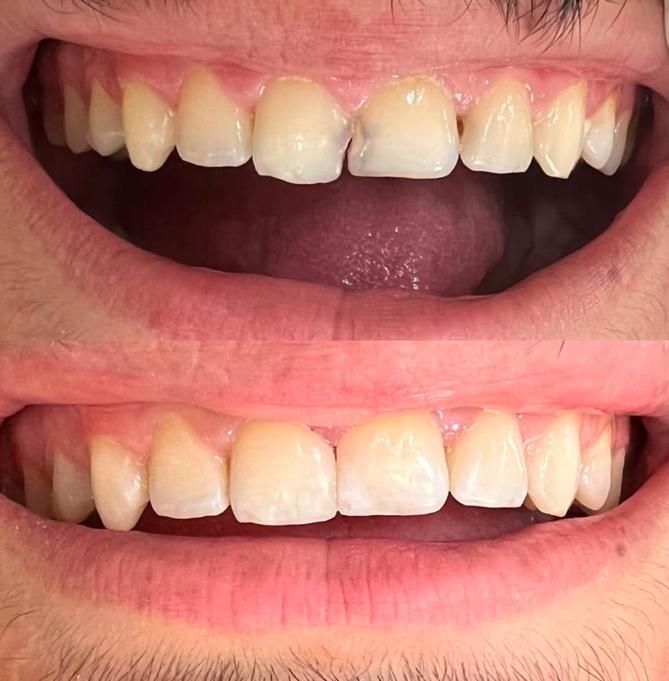 انجام خدمات جرمگیری دندان و ترمیم دندان های پوسیده|خدمات آرایشگری و زیبایی|آبادان, |دیوار