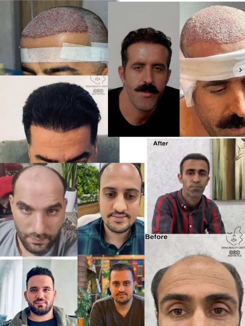 فیلرصورت بوتاکس کربن هایفو لیزرمو ریموتتو جوانسازی|خدمات آرایشگری و زیبایی|یاسوج, |دیوار