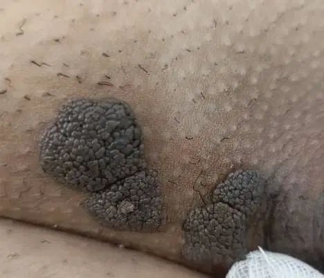 لیزرتتوبدن،ابرو،لیزرخال،زیگیل تناسلی،درمانhpv|خدمات آرایشگری و زیبایی|کرج, گلشهر|دیوار