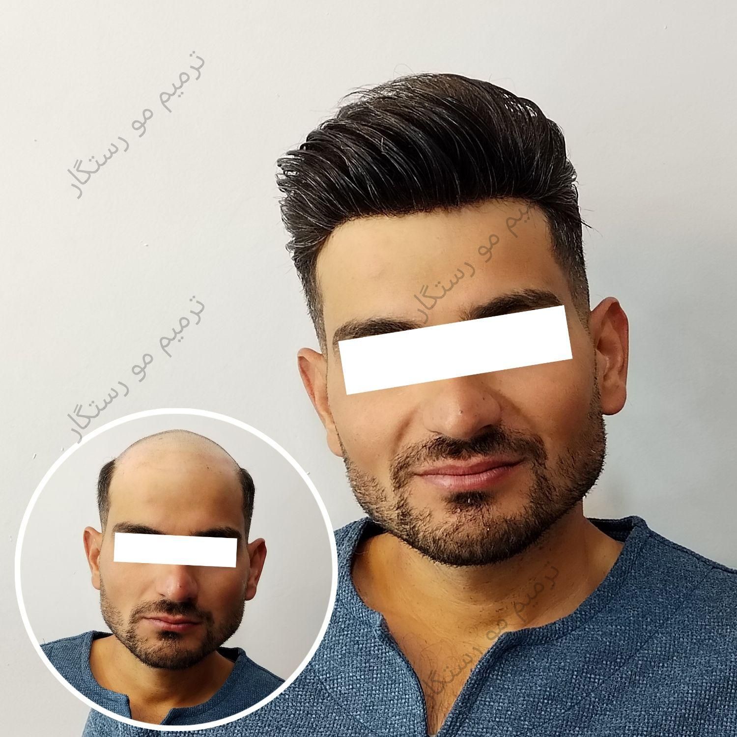 ترمیم مو /پروتز مو / جایگزین کاشت مو و کلاهگیس|خدمات آرایشگری و زیبایی|اصفهان, آبشار|دیوار