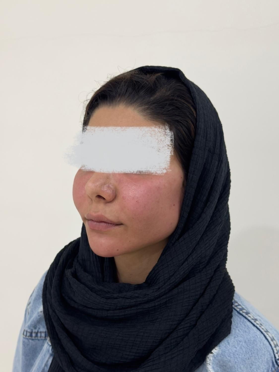 مطب زنان لابیاپلاستی غبغب بوکالفت تزریق چربی|خدمات آرایشگری و زیبایی|تهران, عبدل‌آباد|دیوار
