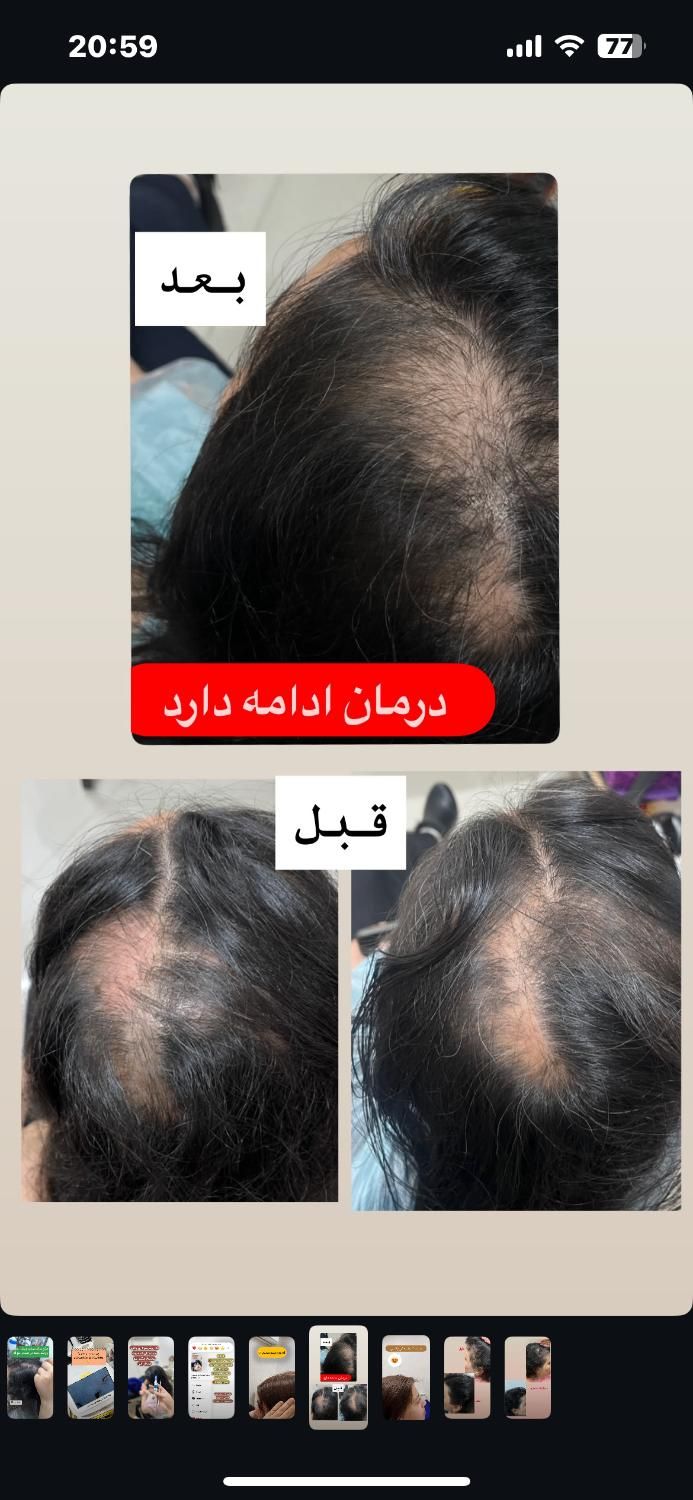 پاکسازی سر،موخوره گیری،اسکالپ،درمان ریزش،رویش مجدد|خدمات آرایشگری و زیبایی|قم, هفت تیر|دیوار