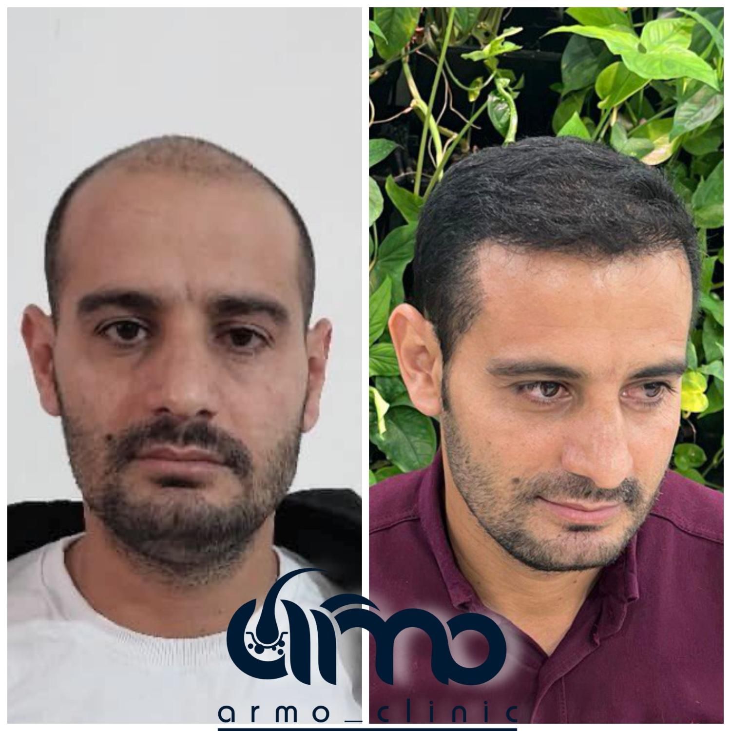 کاشت مو ابرو ریش تکنسین شیرازی|خدمات آرایشگری و زیبایی|قزوین, |دیوار