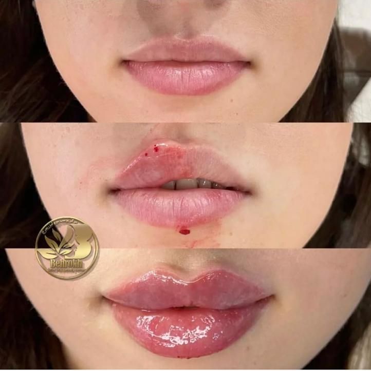 لیزر مو زائد/هایفو تراپی/ژل لب/تزریق چربی/بوتاکس|خدمات آرایشگری و زیبایی|اصفهان, جلفا|دیوار