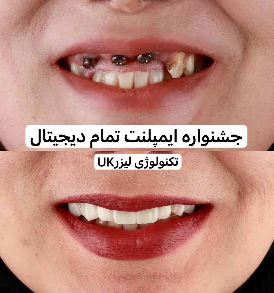هر4واحد ایمپلنت دیجیتال+1ایمپلنت رایگان/کاشت دندان|خدمات آرایشگری و زیبایی|تهران, پاسداران|دیوار