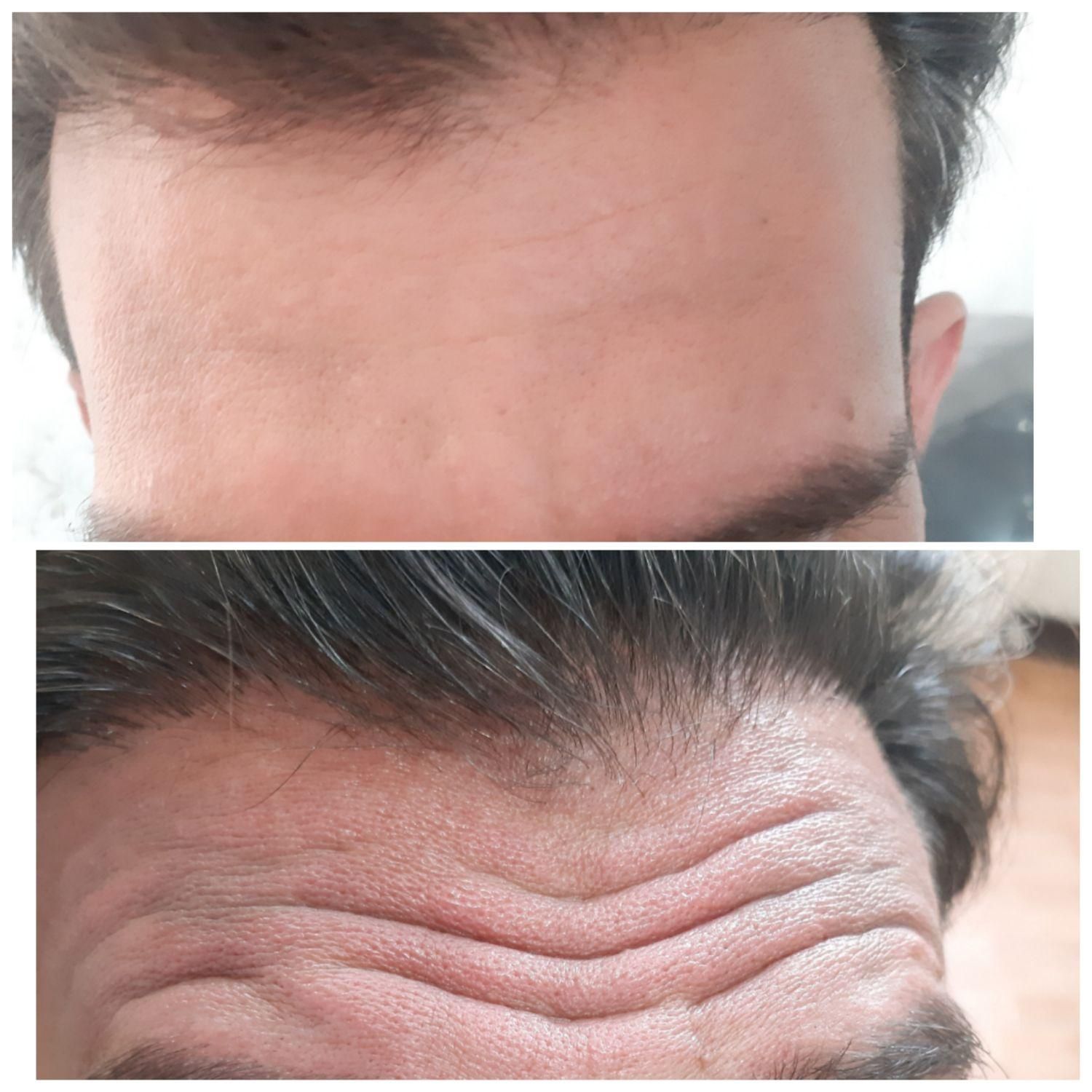 لیزر بوتاکس ژل خالبرداری|خدمات آرایشگری و زیبایی|سیرجان, |دیوار