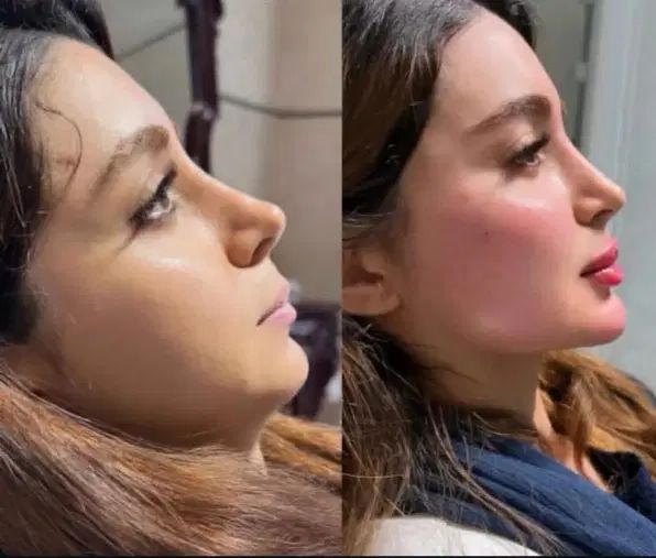 تخفیفات ویژه بوتاکس صورت و فیلر لب،فول فیس و...|خدمات آرایشگری و زیبایی|مشهد, شهید فرامرز عباسی|دیوار