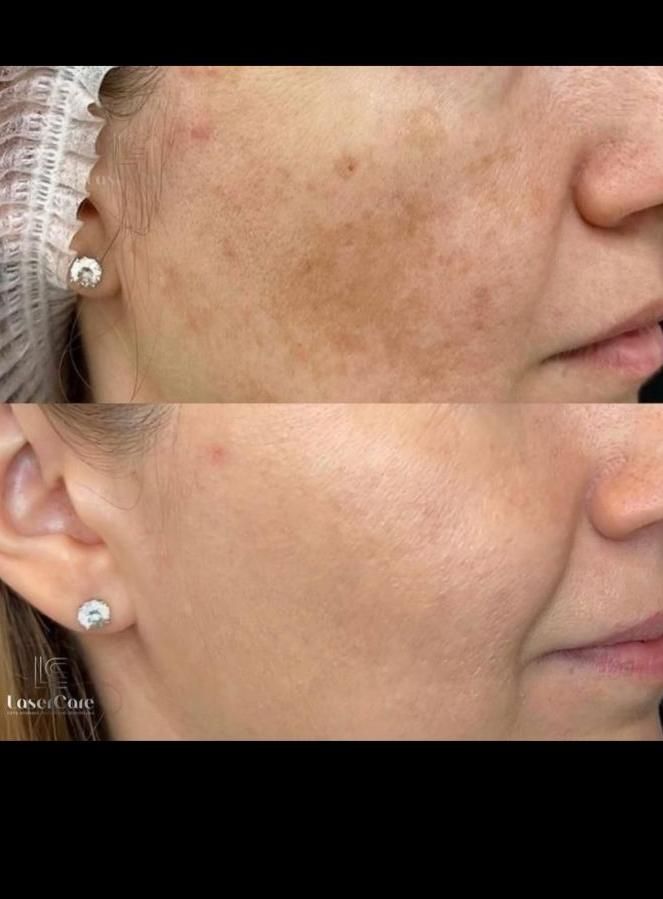 لک صورت بوتاکس خال موی سر ریش|خدمات آرایشگری و زیبایی|اهواز, کیان اباد|دیوار