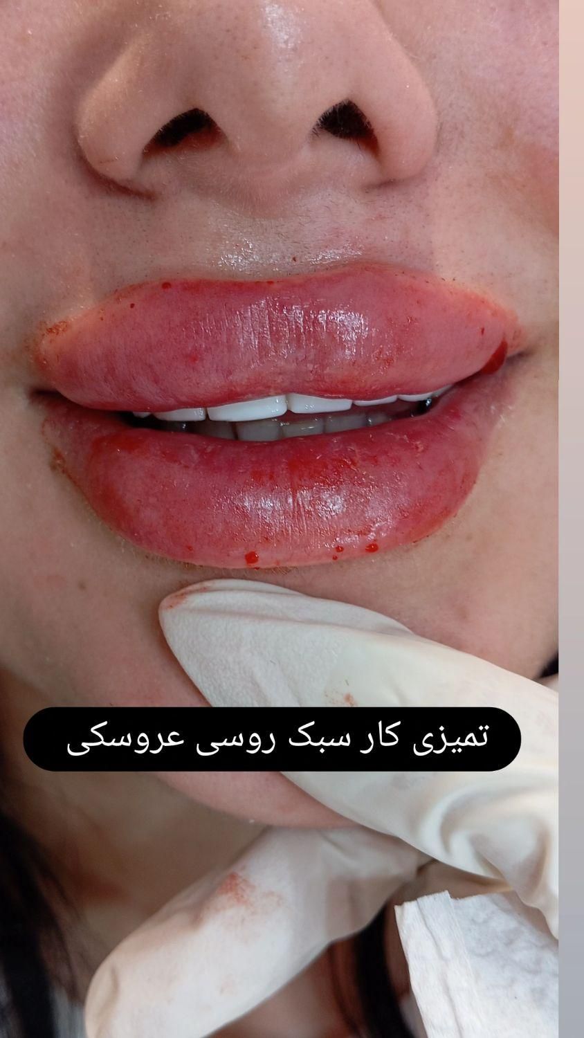 فیلر لب.بوتاکس.مزوژل.لب روسی.|خدمات آرایشگری و زیبایی|بندر انزلی, چهارفریضه|دیوار