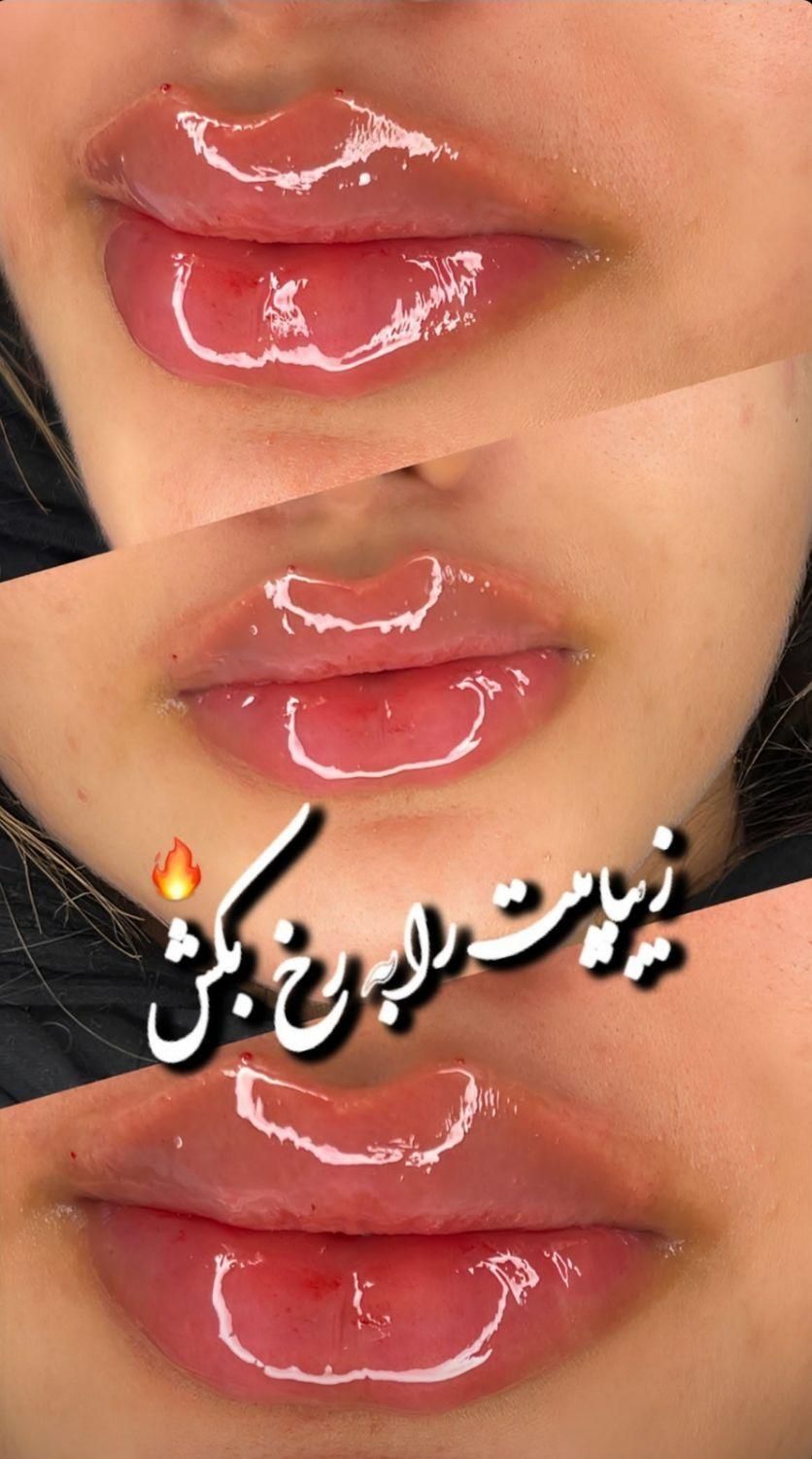 تزریق واموزش ژل بوتاکس مزوتراپی لیفت نخ...|خدمات آرایشگری و زیبایی|کرمانشاه, |دیوار