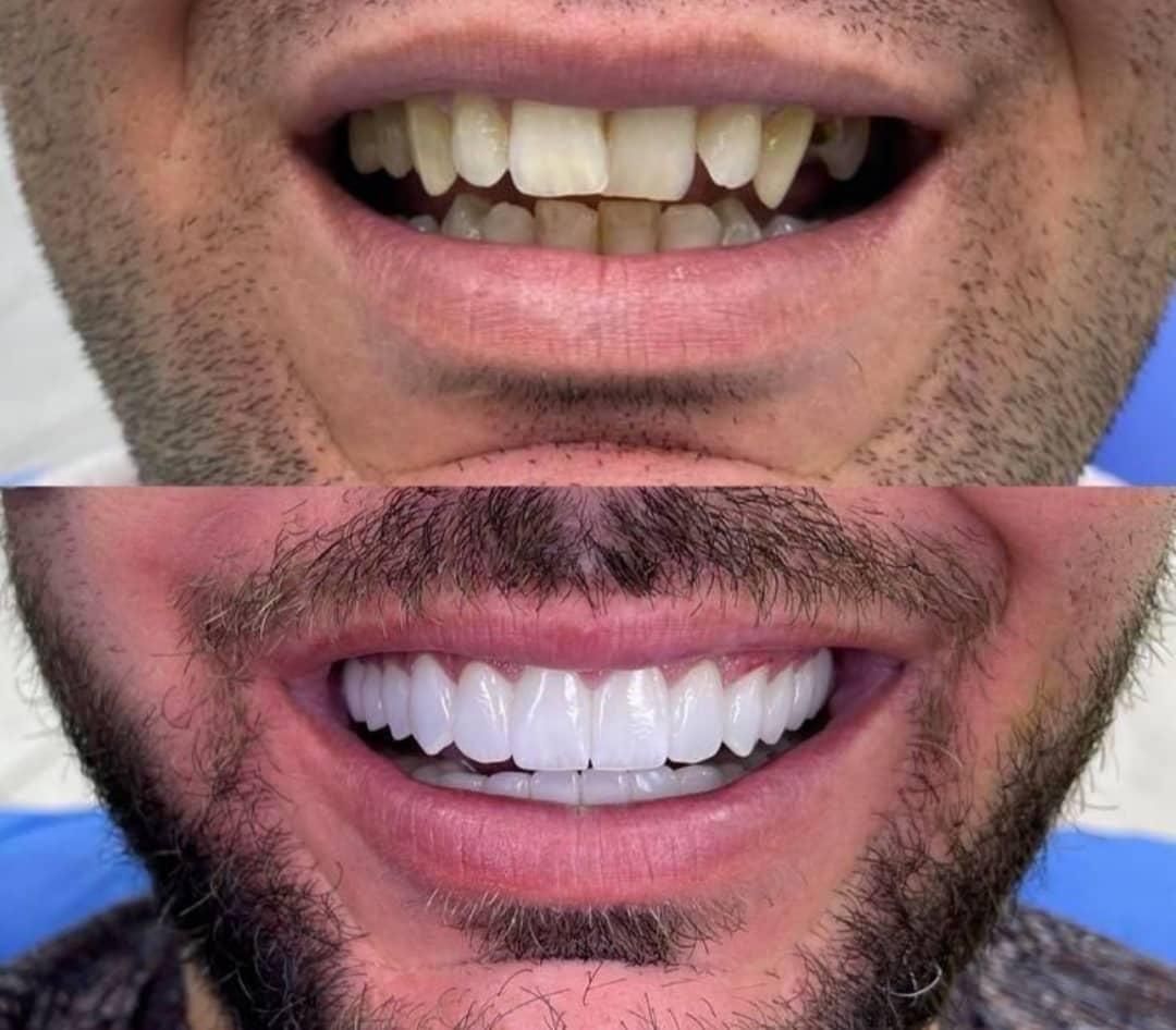 دندانپزشکی بدون پیش پرداخت عصب کشی . کامپوزیت و...|خدمات آرایشگری و زیبایی|قم, عمار یاسر|دیوار