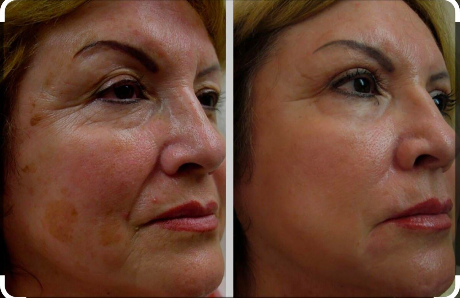 تزریق ژل،بوتاکس،سابسیژن،پی آرپی،مطب درمانی وزیبایی|خدمات آرایشگری و زیبایی|خرم‌آباد, |دیوار