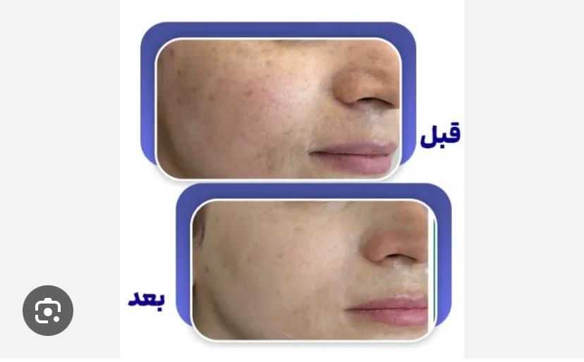 حذف انواع ککومک لک ملاسما و تیرگی در یک جلسه|خدمات آرایشگری و زیبایی|همدان, |دیوار