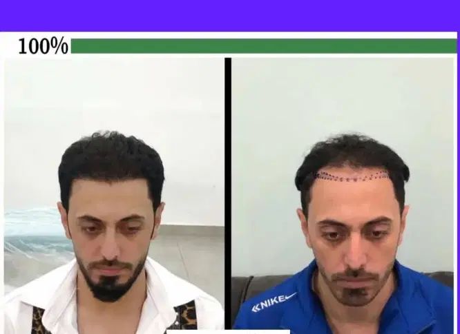 کاشت موکاشت ابرو+ اموزش کاشت مو نقد، اقساط تضمینی|خدمات آرایشگری و زیبایی|شیراز, عفیف‌آباد|دیوار