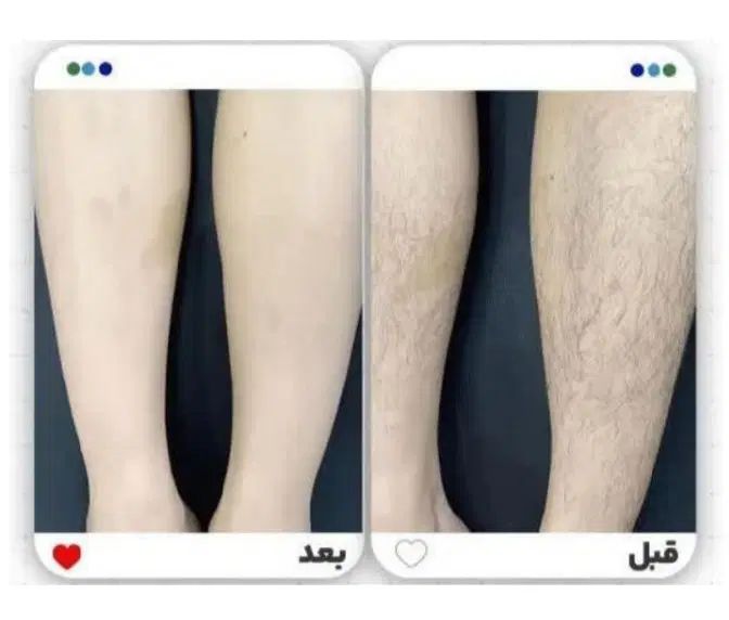 آموزش مرکز لیزر مو طول موج کندلا لیزر بانوان لیزر|خدمات آموزشی|اصفهان, خواجو|دیوار