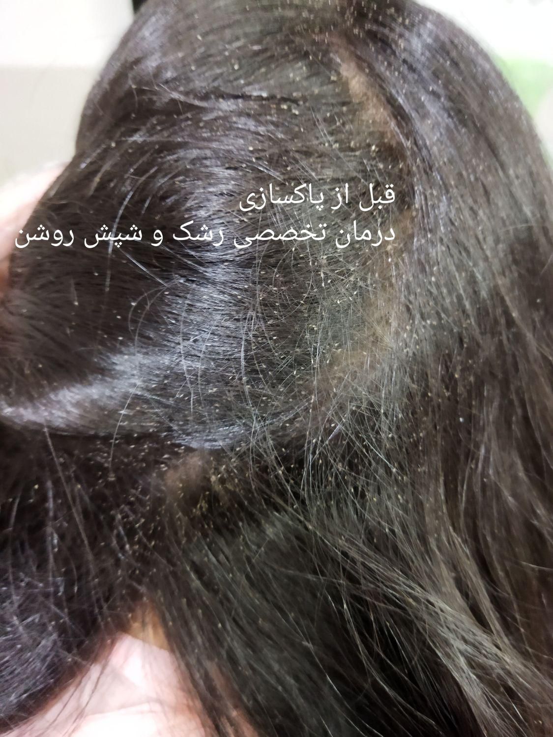 درمان سریع و گیاهی رشک و شپش بدون مواد شیمیایی|خدمات آرایشگری و زیبایی|یزد, |دیوار