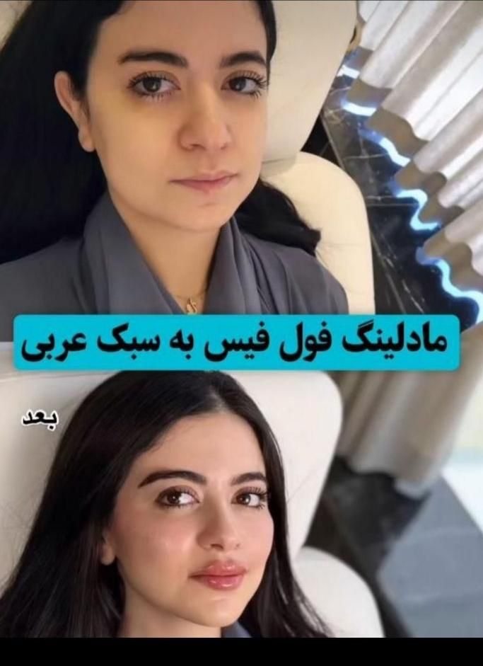 پکیج طلایی نقره ایی برنز لیفت با فیلر ژل بوتاکس|خدمات آرایشگری و زیبایی|مشهد, سناباد|دیوار
