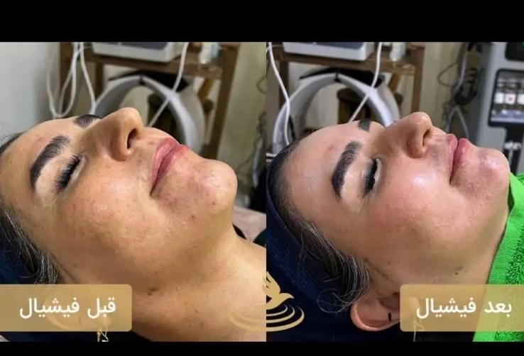 فیشال(پاکسازی) اقتصادی صورت vip|خدمات آرایشگری و زیبایی|محمدیه-قزوین, |دیوار