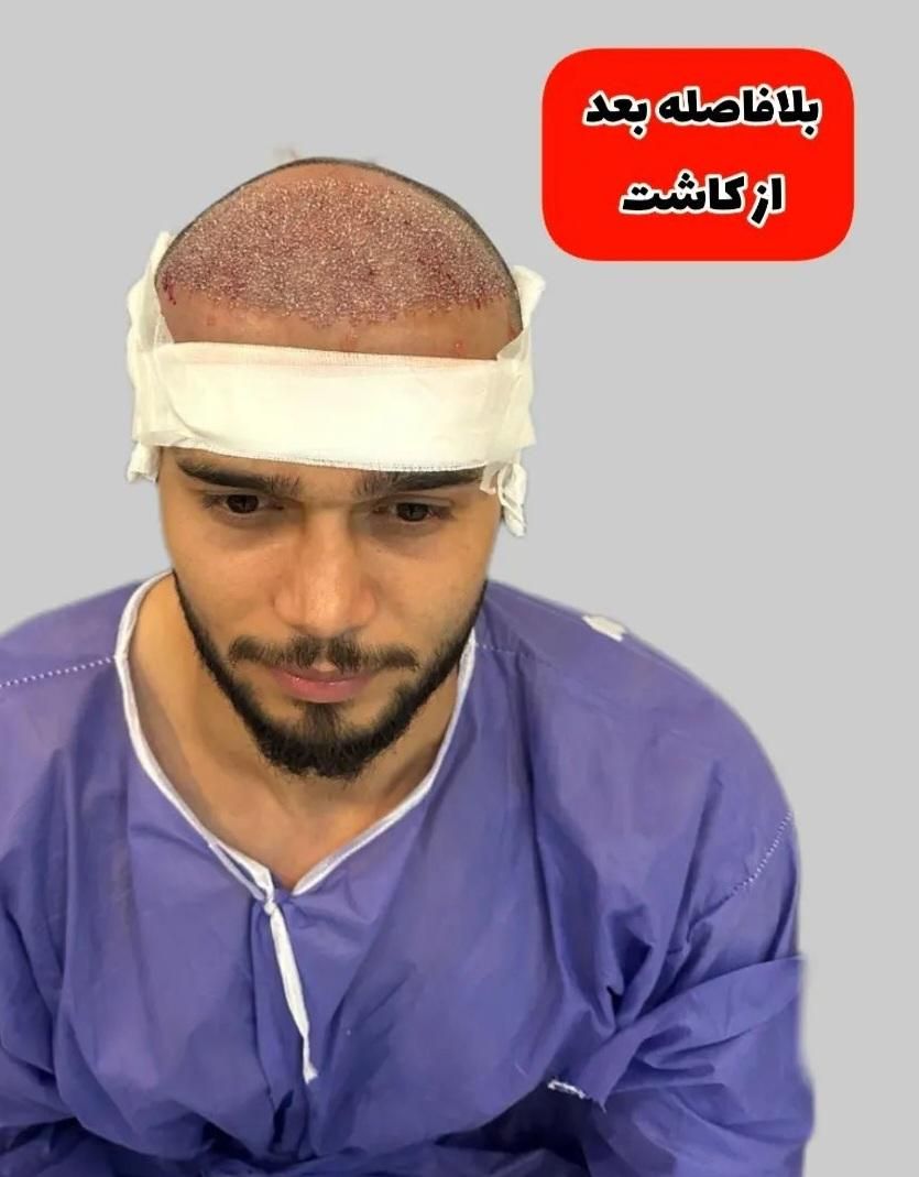 کاشت مووابرو با تخفیف درکلینیک تخصصی تبریز|خدمات آرایشگری و زیبایی|اردبیل, |دیوار