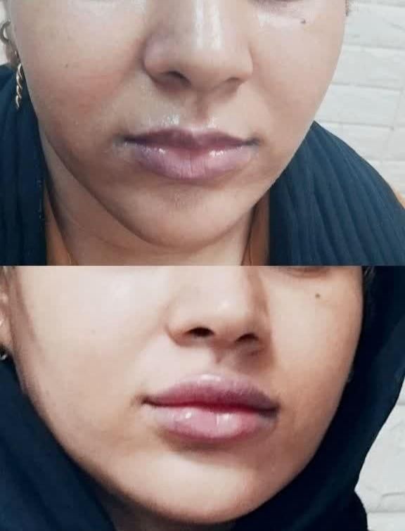 تزریق ژل لب.گونه.چانه.زاویه سازی فک.آنزیم بینی|خدمات آرایشگری و زیبایی|اردکان, |دیوار
