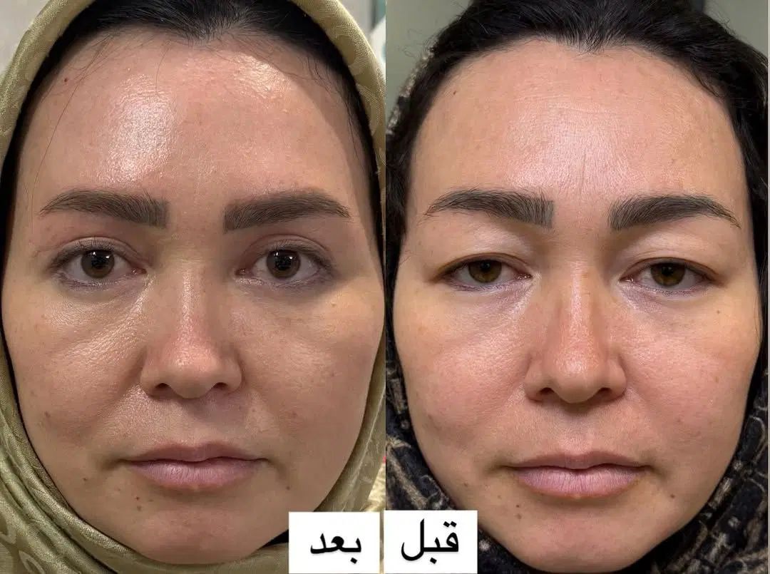 بلفاروپلاستی فقط با ۹ میلیون تومان در تهران|خدمات آرایشگری و زیبایی|باقرشهر, |دیوار