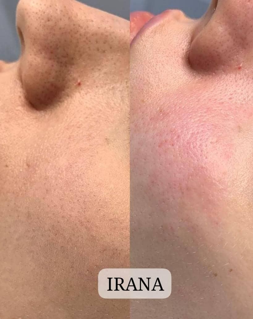 سفیدکردن بیکینی،زیربغل،صورت (کلینیک ایرانا)|خدمات آرایشگری و زیبایی|یاسوج, |دیوار