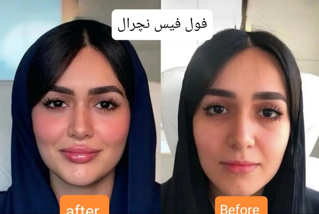جشنواره/فیلر/بوتاکس/آنزیم/تخفیف دکترفیروزی|خدمات آرایشگری و زیبایی|شیراز, زرهی|دیوار