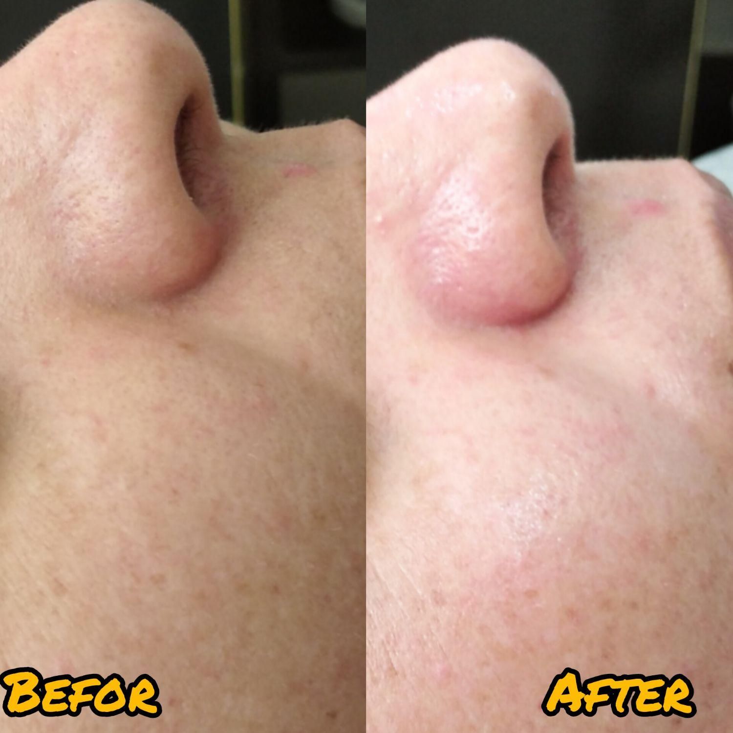 درمان تخصصی پوست و خالبرداری|خدمات آرایشگری و زیبایی|فولادشهر, B2|دیوار