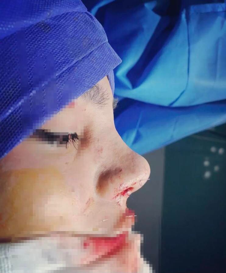 جراحی بینی عمل بینی انواع جراحی زیبایی|خدمات آرایشگری و زیبایی|ساری, |دیوار